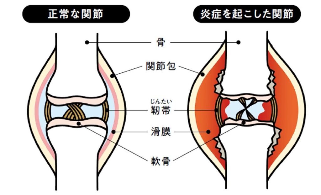 関節リウマチの場合、どれくらいの量の水を飲むべきですか?